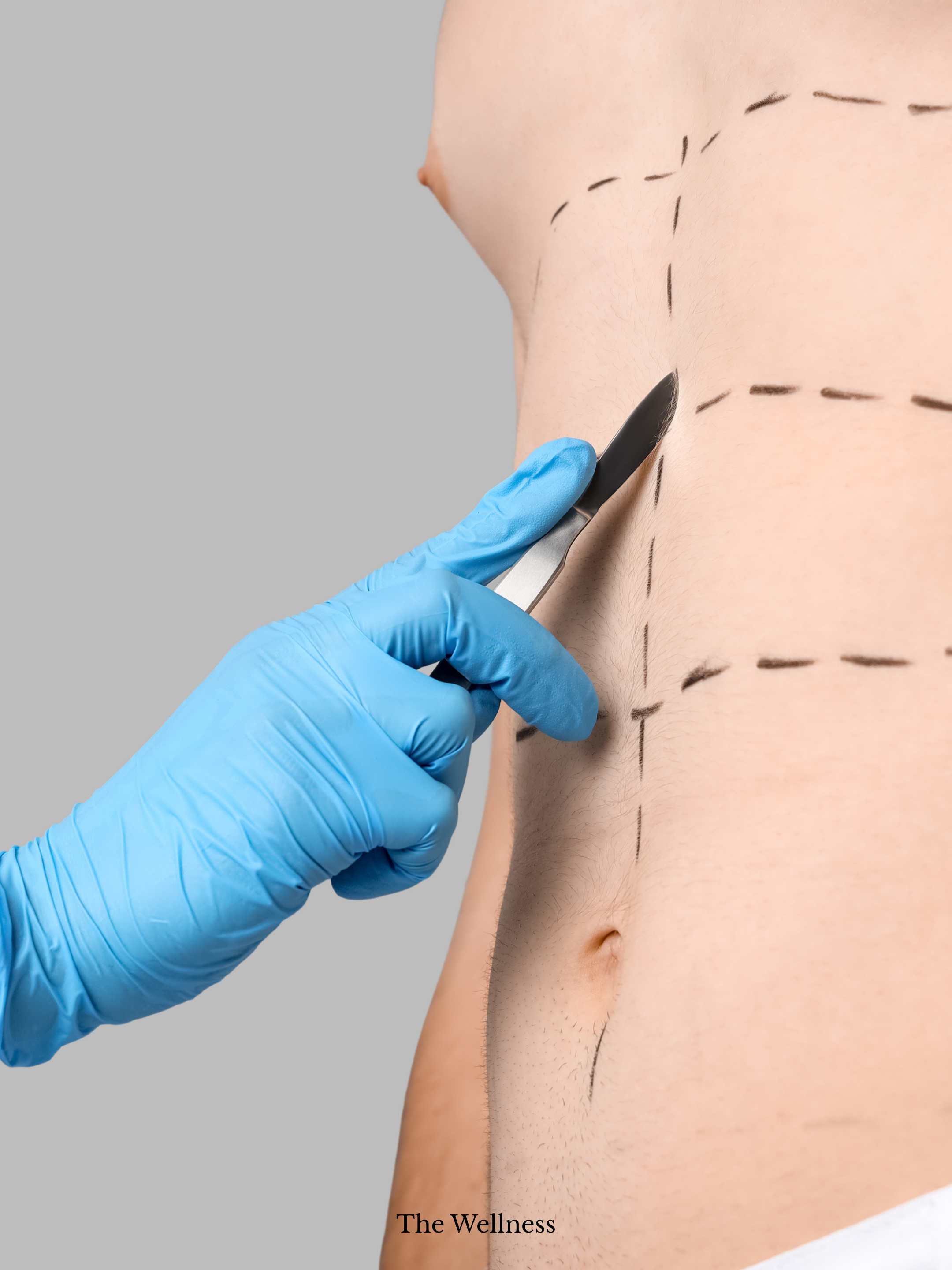 The Secret Plastic Surgeons Use for Invisible Scars