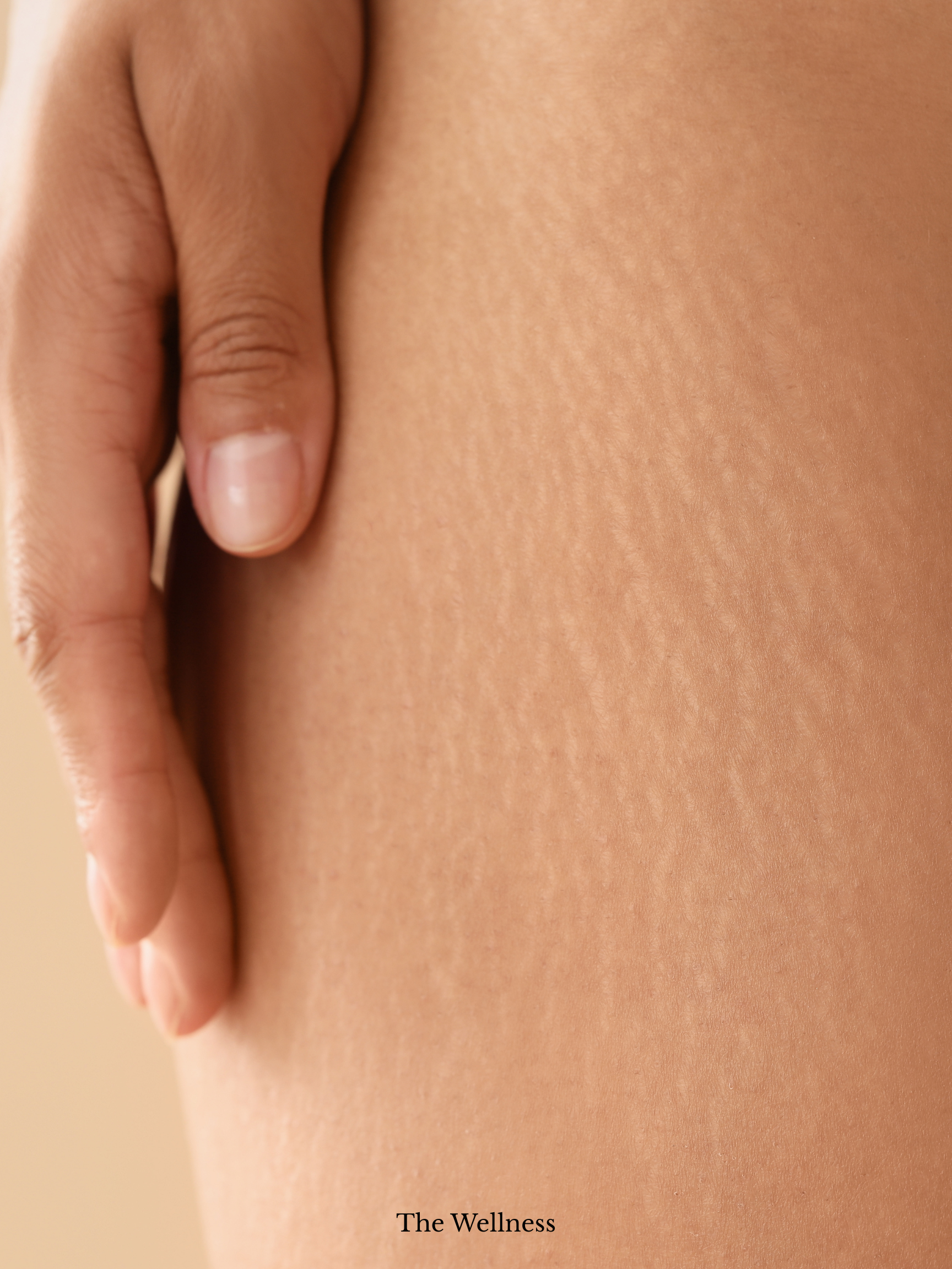 Stretch Marks and Body Scars: Can PRP Really Fade Them?