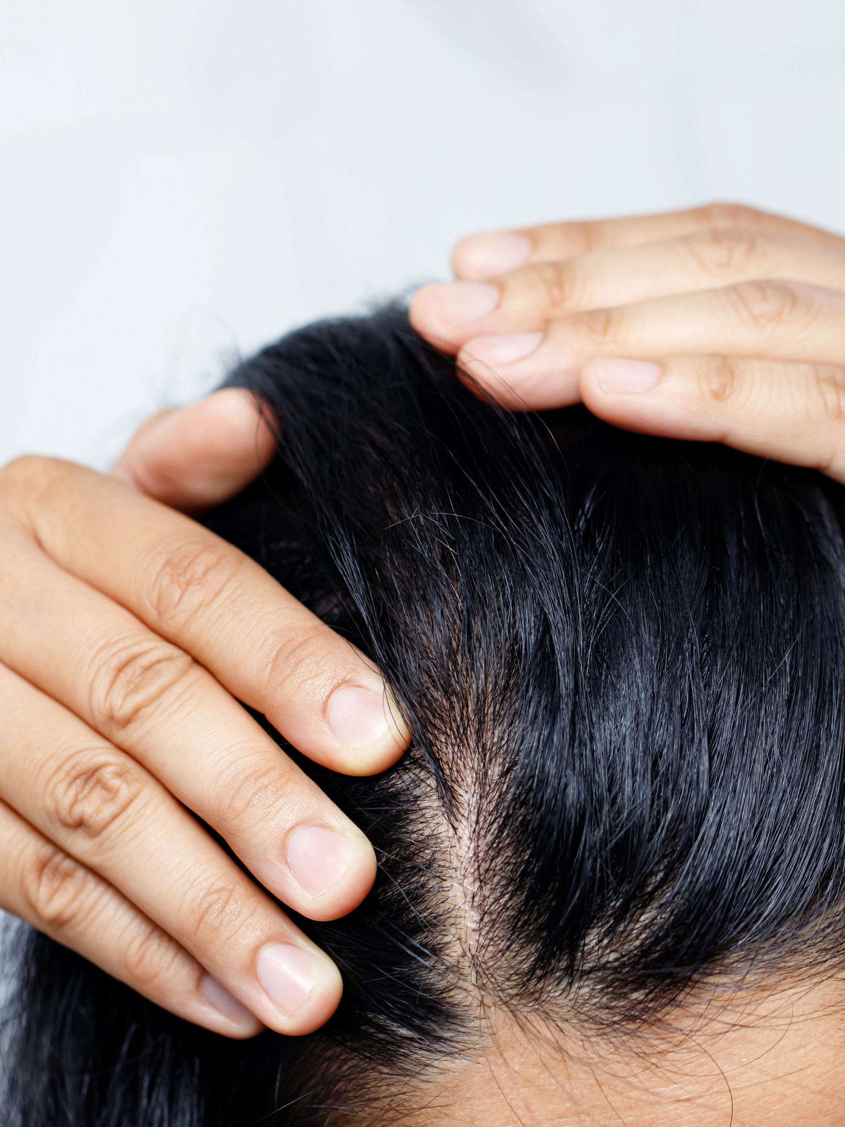 PRP vs Hair Transplant - Which Is Right for Your Hair Loss
