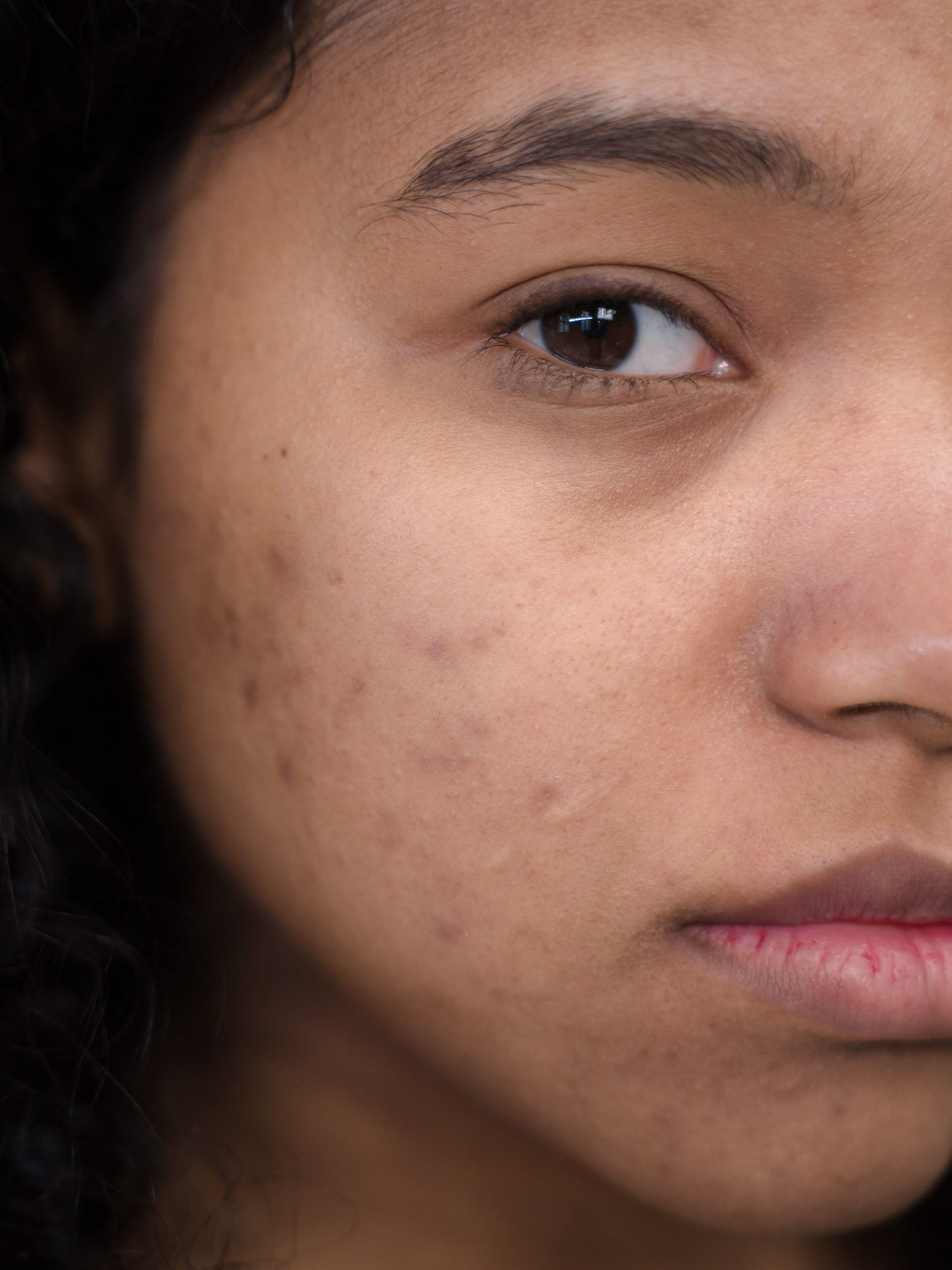 PRP for Acne Scars London - Can Platelet Therapy Fix Scarring?