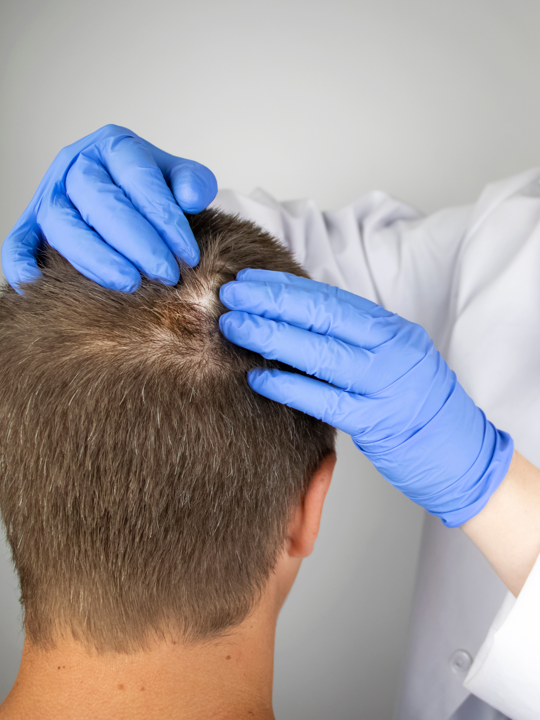 Alopecia Areata Treatment London - When Hair Loss Comes in Patches