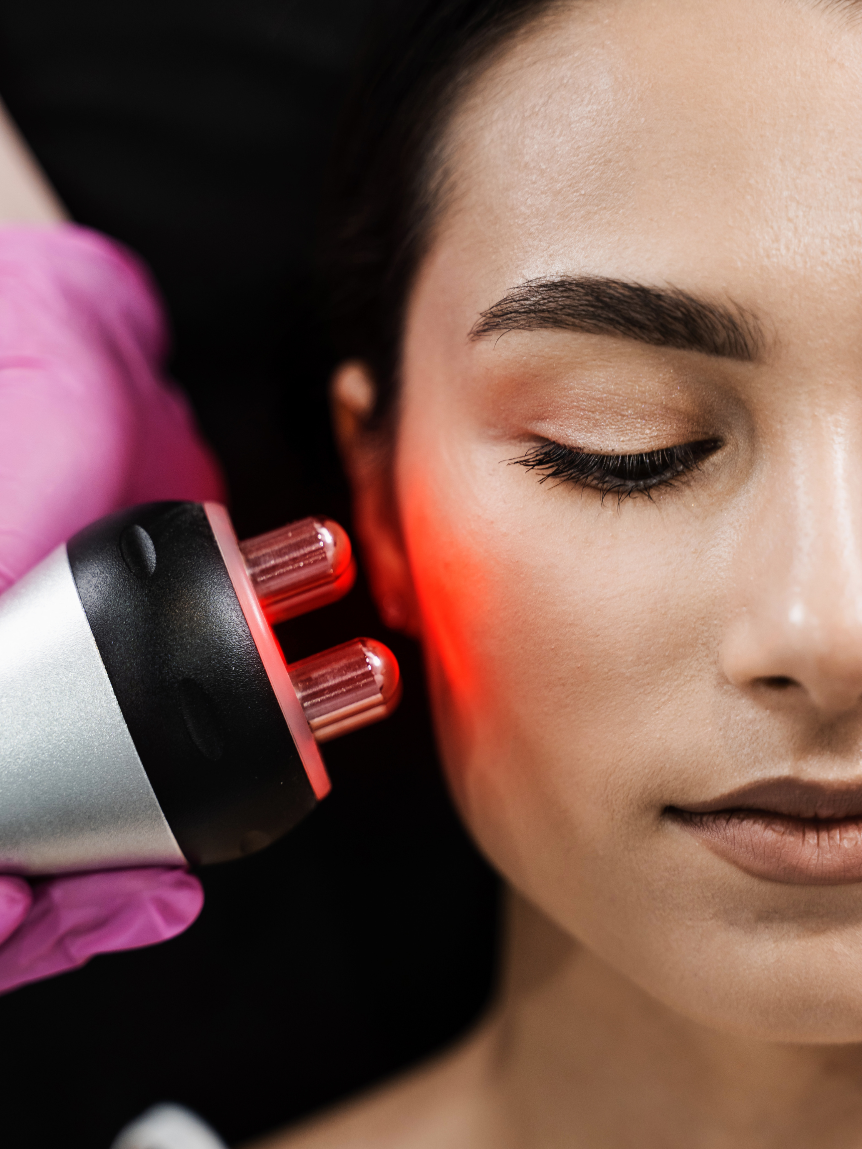 Skin Tightening and Laxity Treatment London - Beyond Fillers