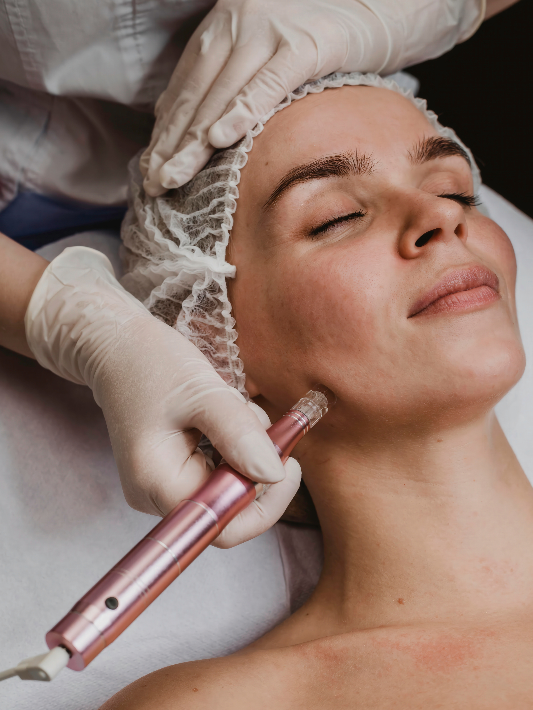 PRP Facial London (Vampire Facial)