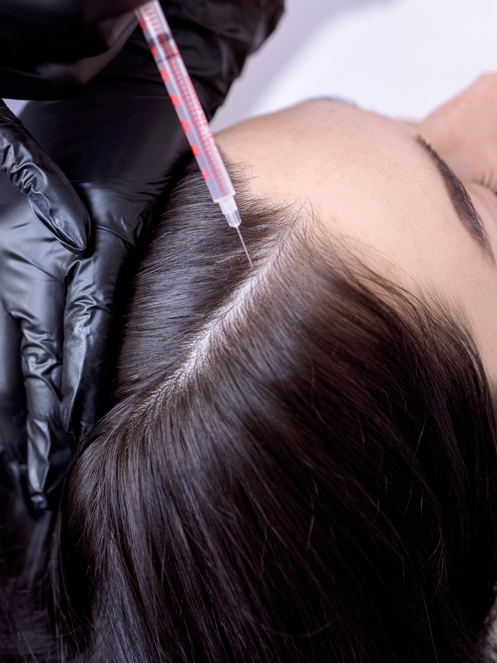 How Many PRP Sessions for Hair