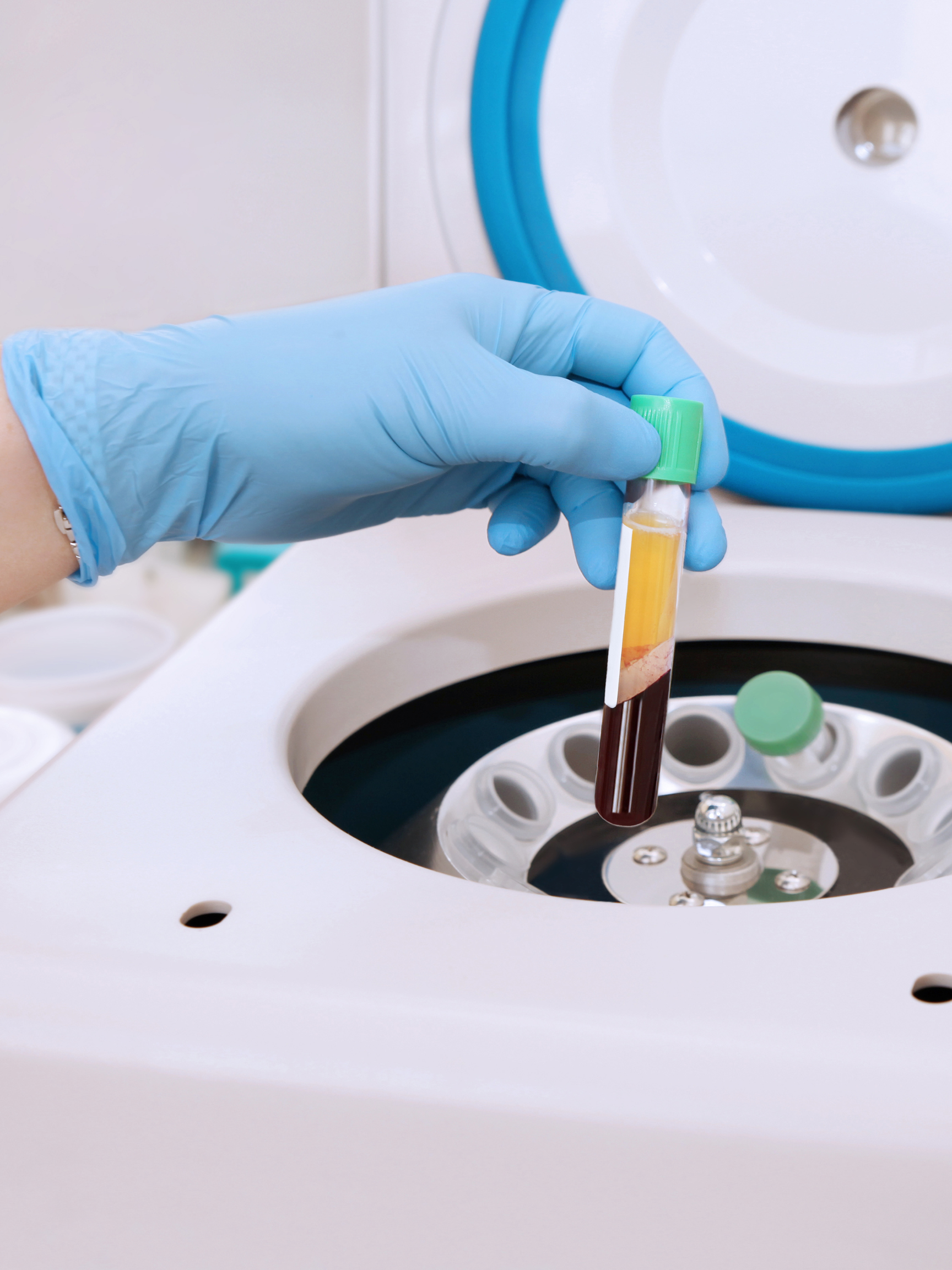 PRP Treatment Cost London: Understanding Pricing and Value for Hair Restoration