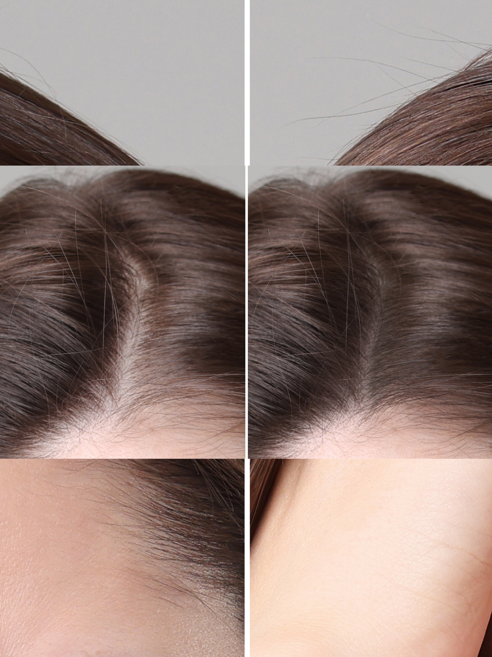 PRP Hair Treatment Before and After