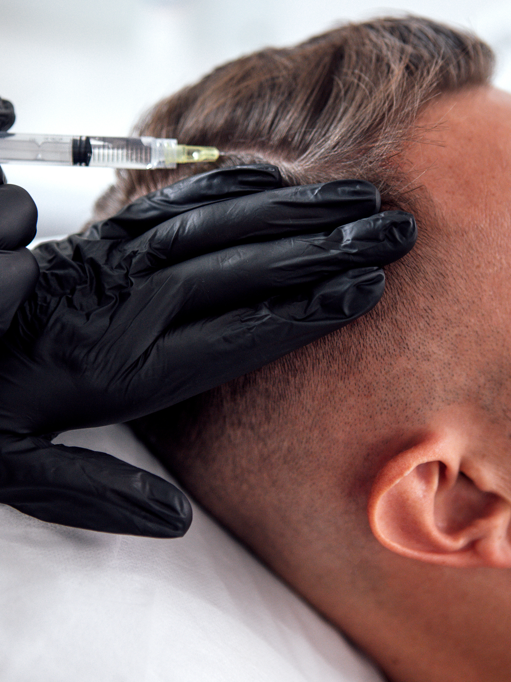PRP Injections for Hair Loss