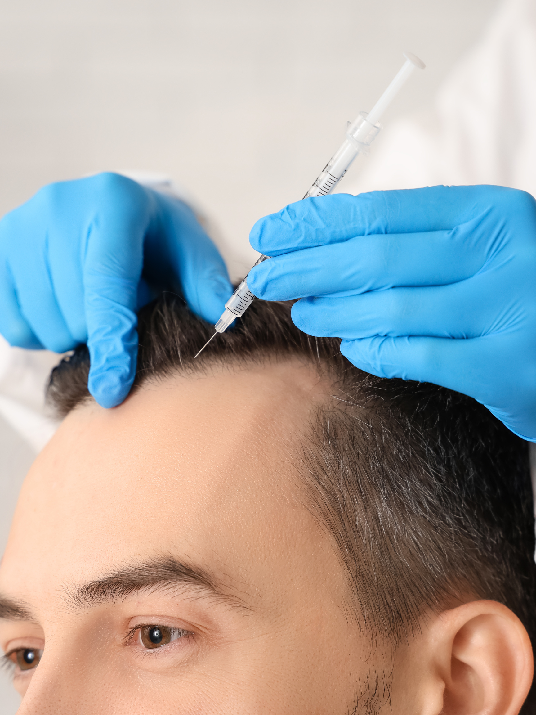 PRP vs Hair Transplant