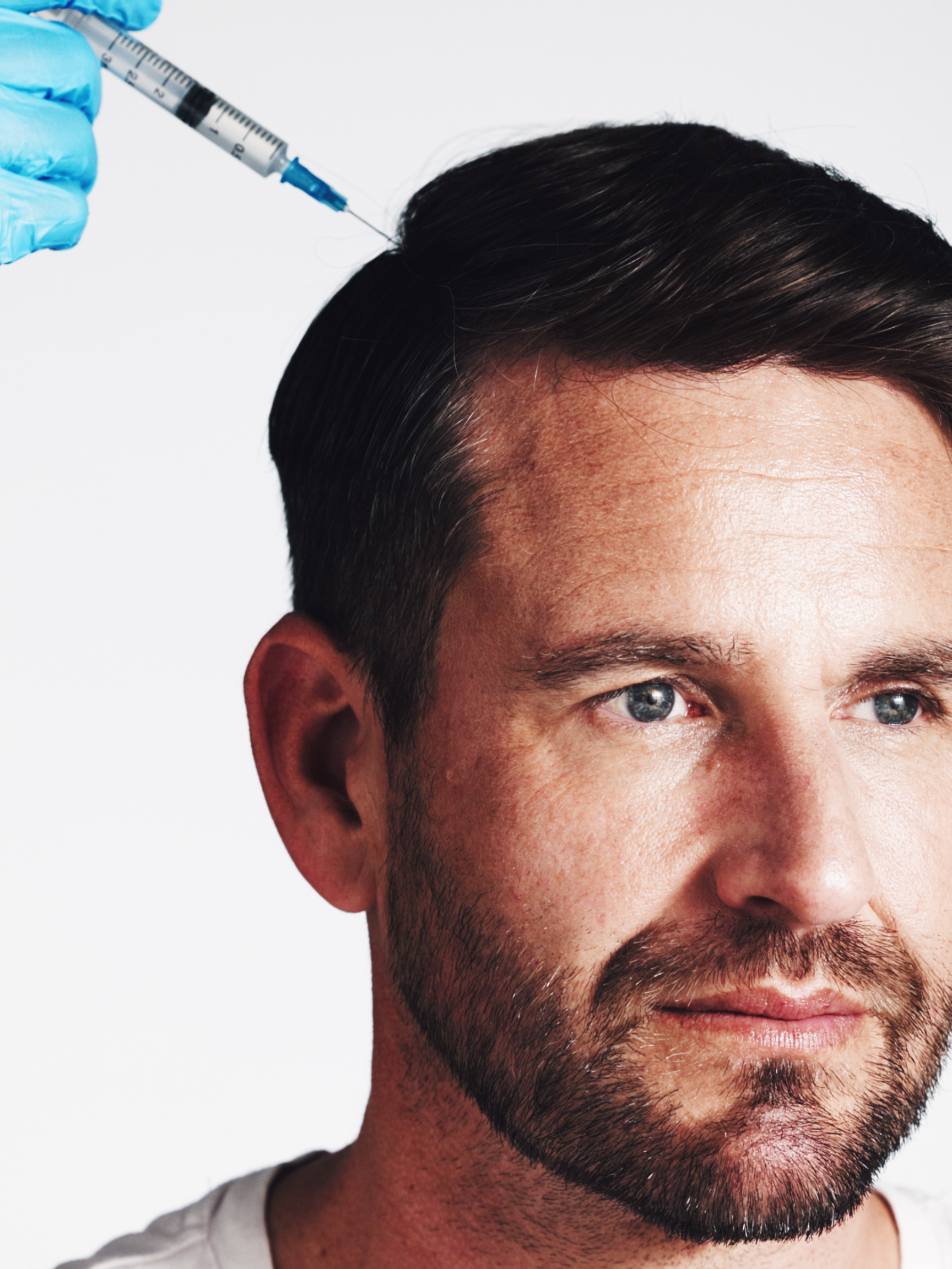 Does PRP Work for Hair Loss