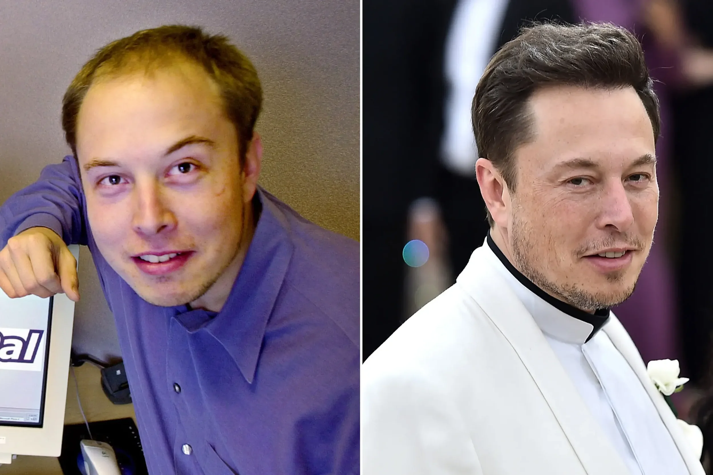 How Did Elon Musk Get His Hair Back? The Complete Hair Transplant Breakdown