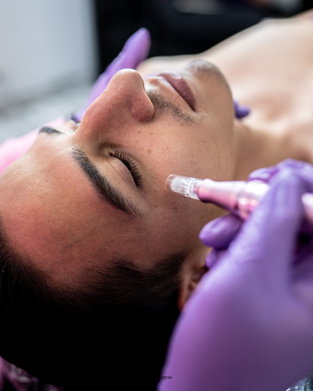 Microneedling for Hair Growth in London: How It Works, What the Evidence Says, and Why It's Better With PRP or Exosomes