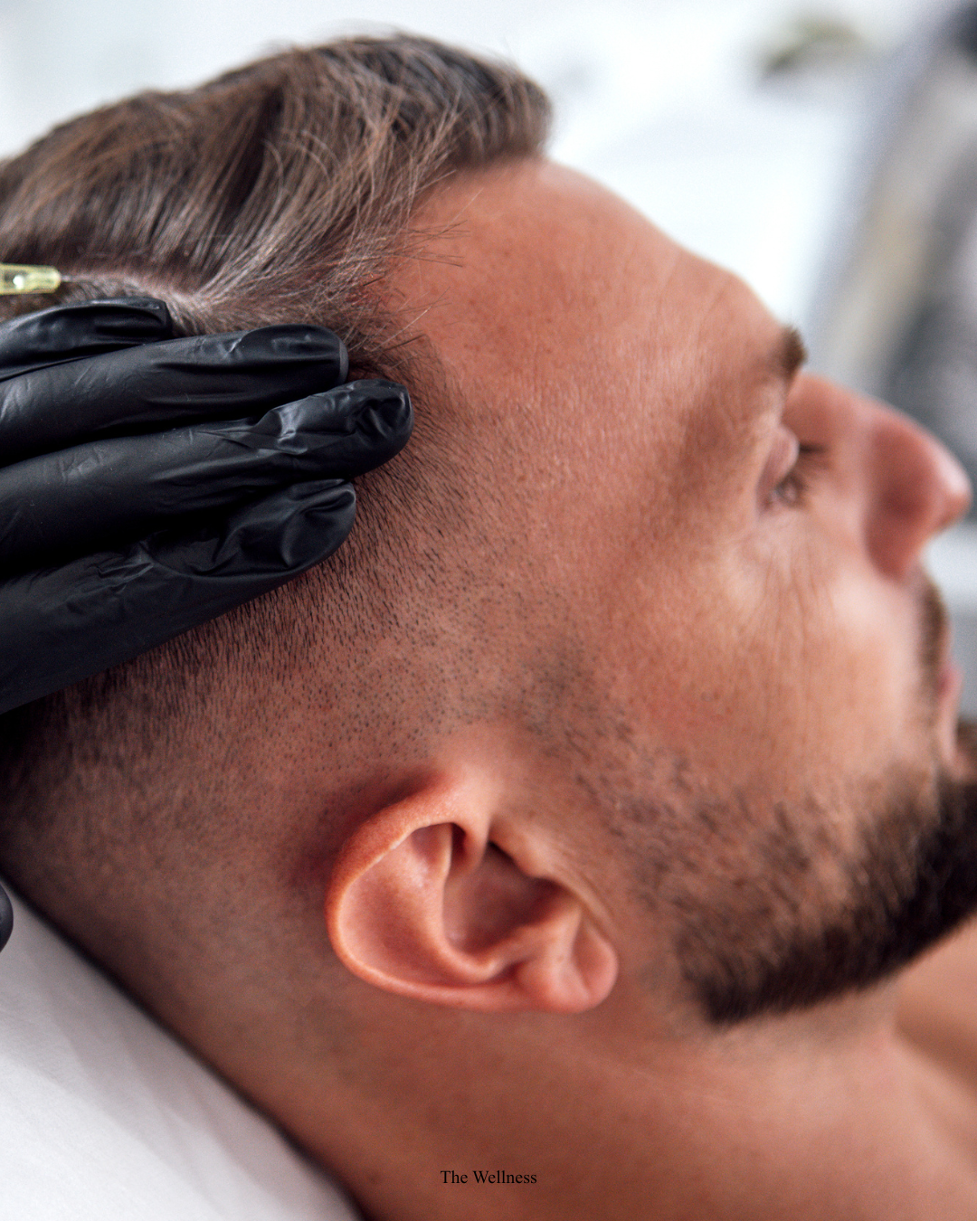 PRP vs Exosomes for Hair Loss: Which Treatment Is Right for You in 2026?