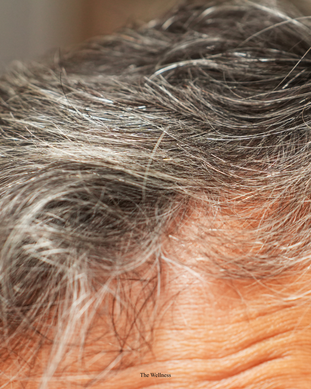 DHT and Hair Loss: How This Hormone Causes Baldness and How to Stop It (2026)