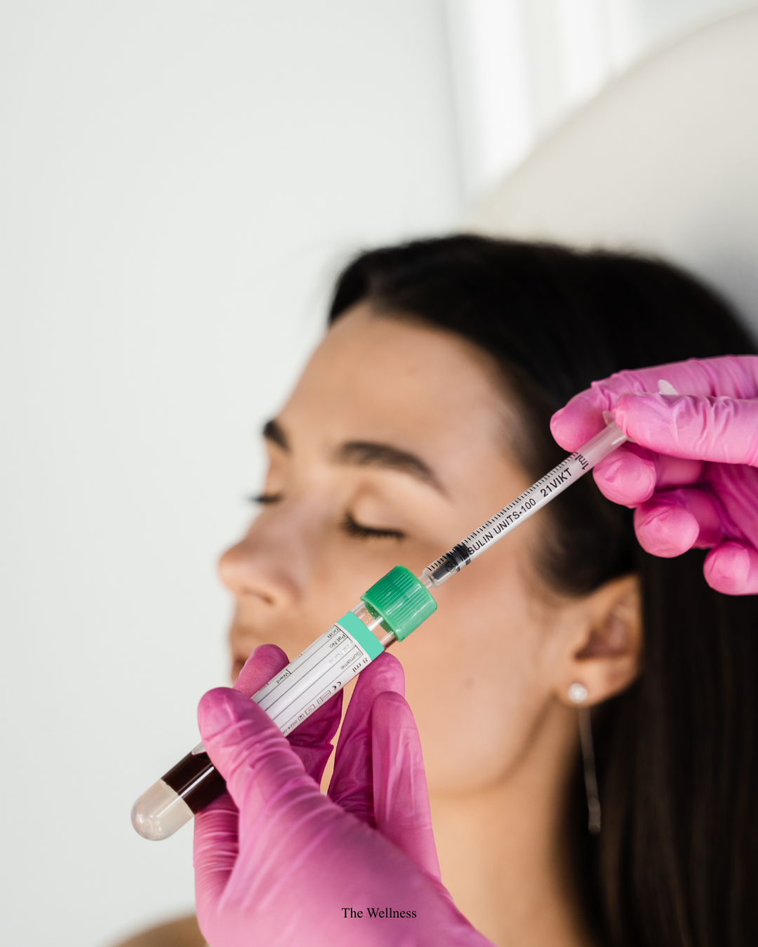 PRP Facial London (Vampire Facial): Everything You Need to Know Before Booking (2026)