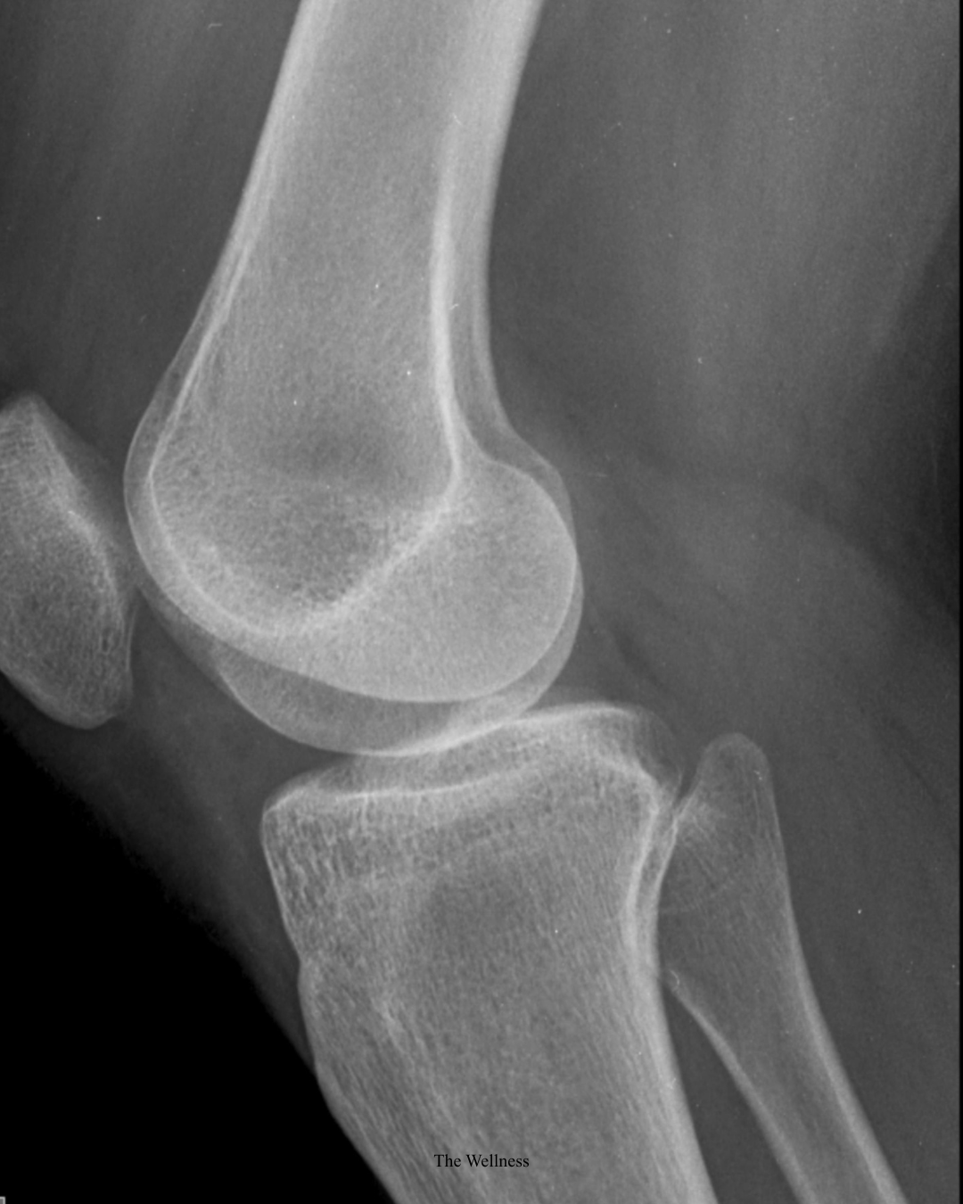 PRP for Knee Pain London: Can Regenerative Injection Therapy Replace Surgery? (2026)