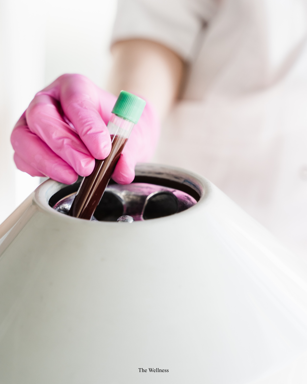 PRP for Acne Scars: Can Platelet-Rich Plasma Repair Scarred Skin? (2026 Evidence Guide)