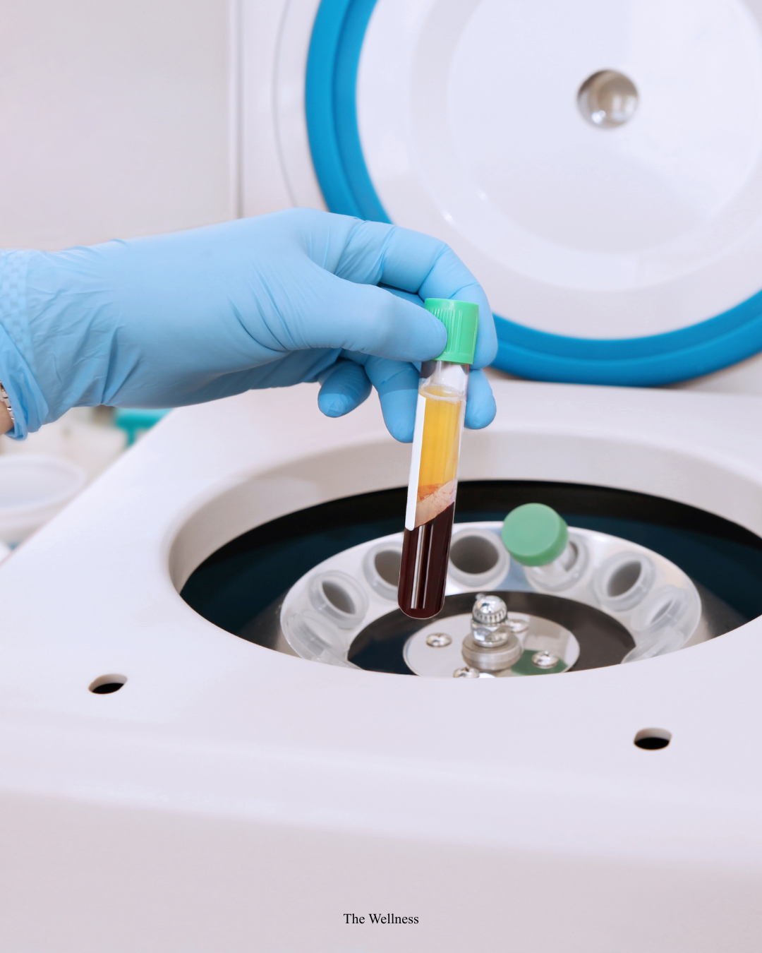 PRP Side Effects: Is Platelet-Rich Plasma Treatment Safe? (Complete 2026 Safety Guide)