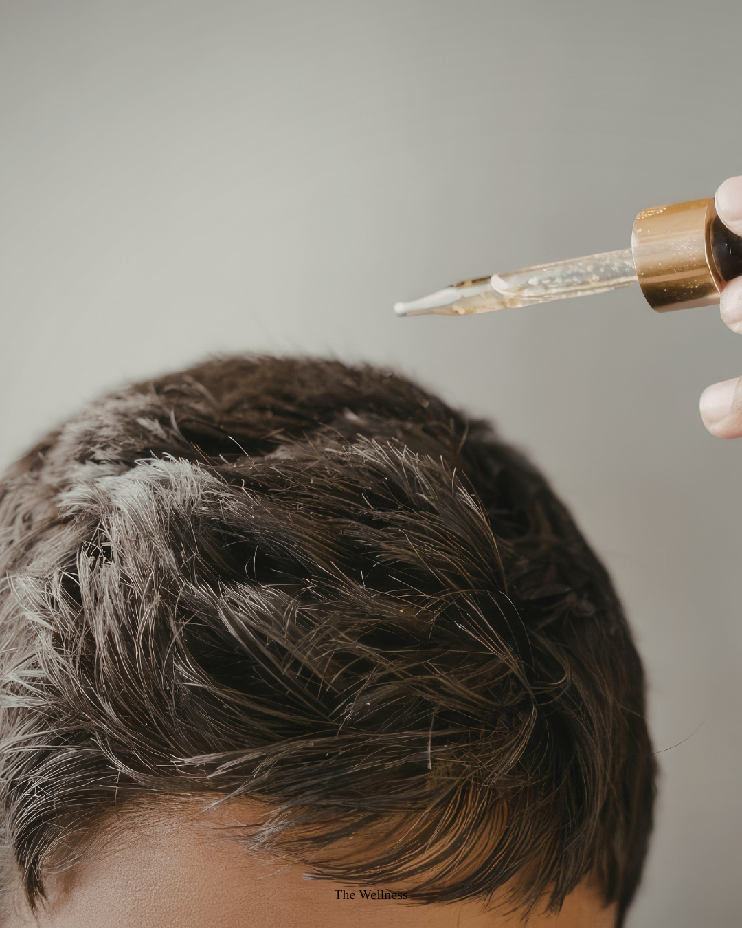 Crown Thinning and Bald Spot Treatment: How to Restore Density at the Crown (2026)