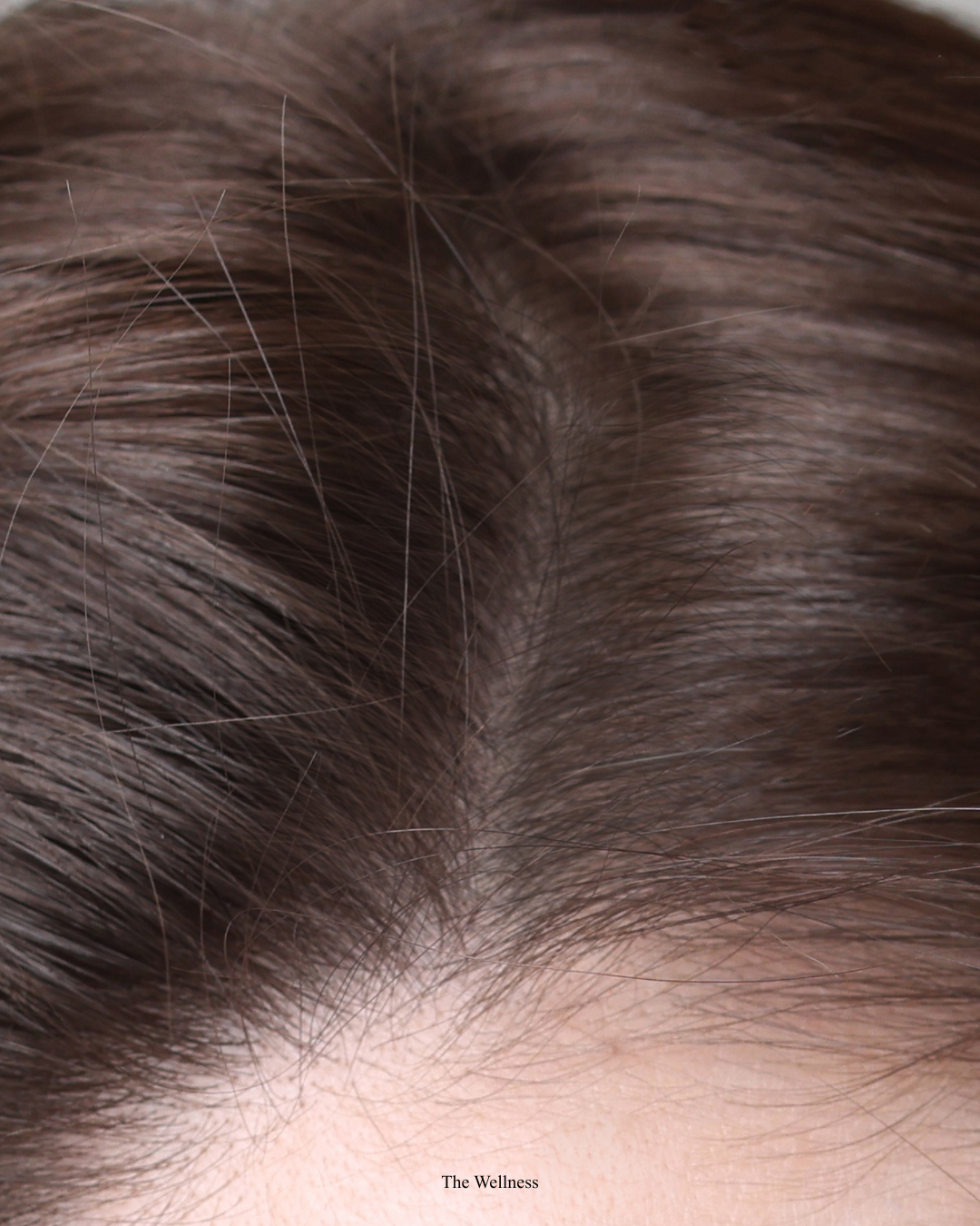 Best PRP Clinic in London: How to Choose and Why Price Is Not What You Should Compare (2026)