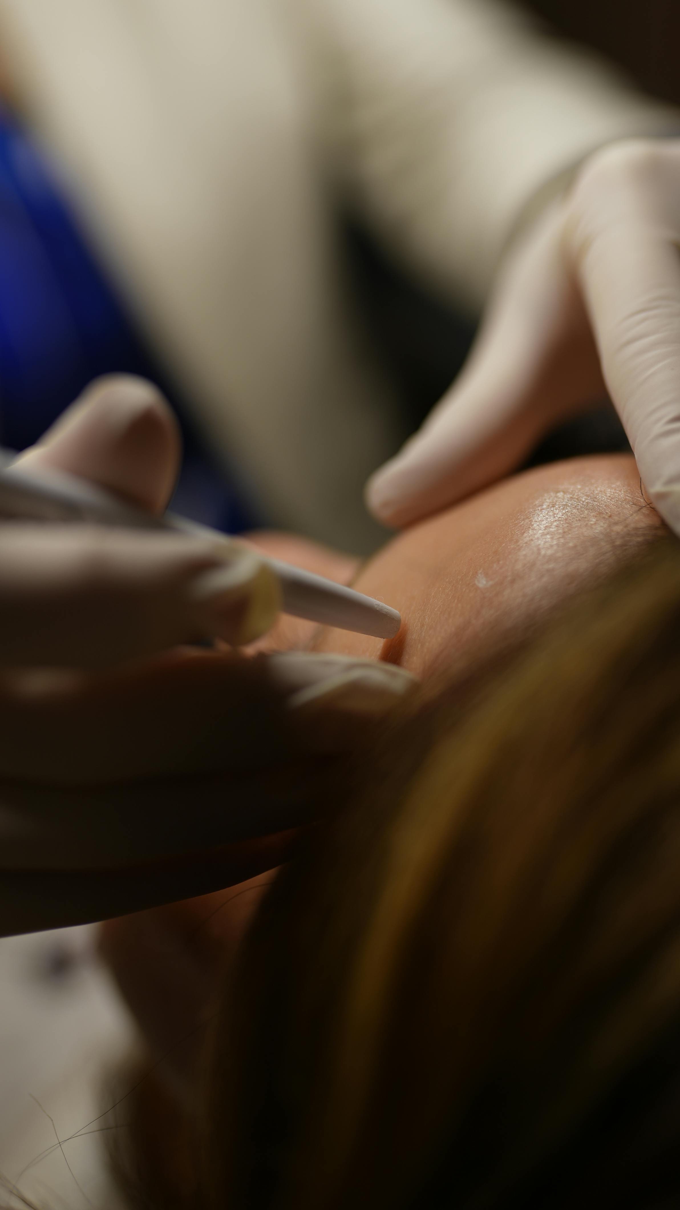 Microneedling Facial London: What It Does, What It Costs, and Is It Worth It? (2026)