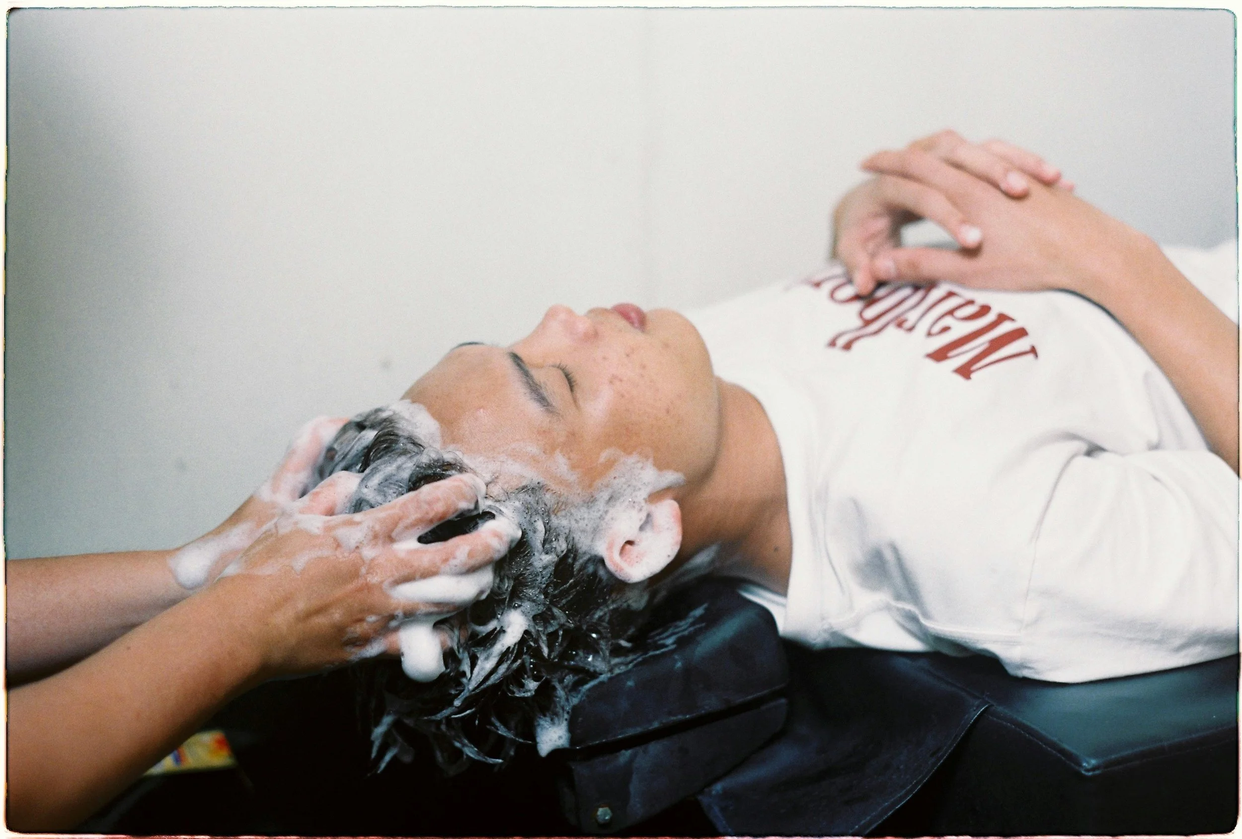 Scalp Micropigmentation vs PRP London. Which Is Right For You