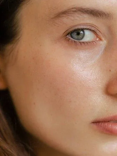 Best Under-Eye Treatment in London 2026. Matching the Treatment to Your Cause