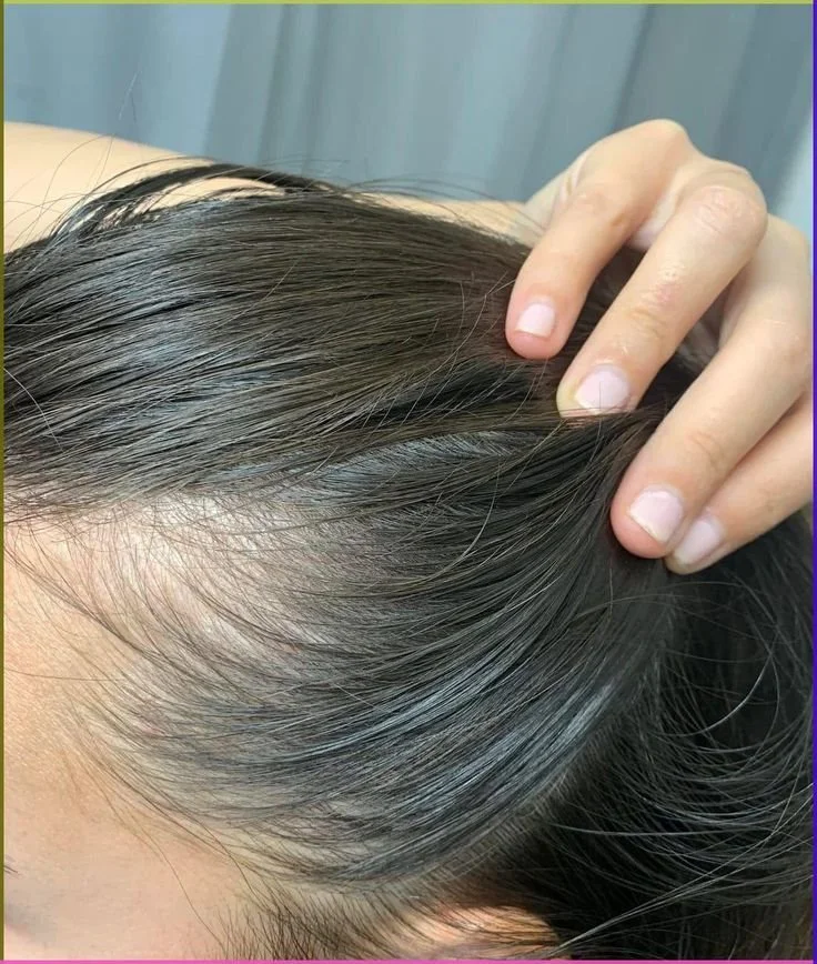 Menopause Hair Loss in London 2026. Why It Happens, What the Bloods Must Rule Out, and the Treatments That Actually Have Evidence