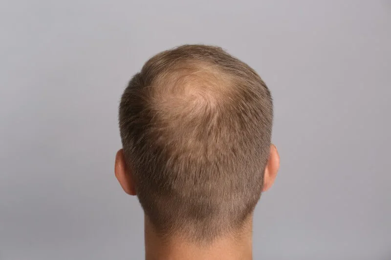 Thinning Crown And Vertex. Treatment For The Back Of The Head