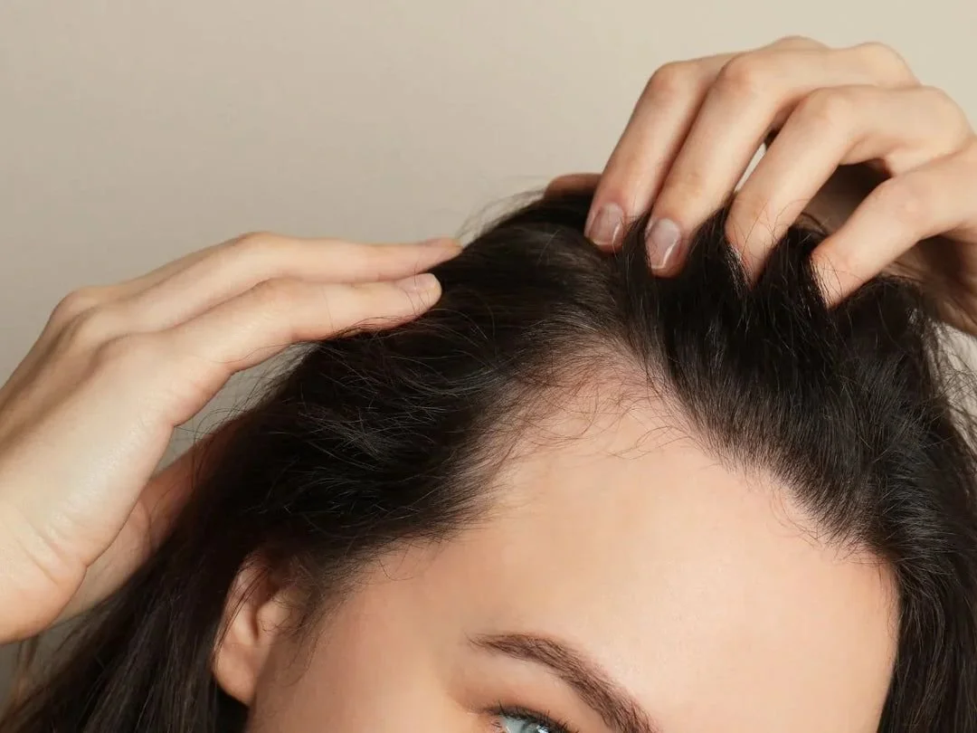 PCOS Hair Loss Treatment London. Why It Happens And What Works
