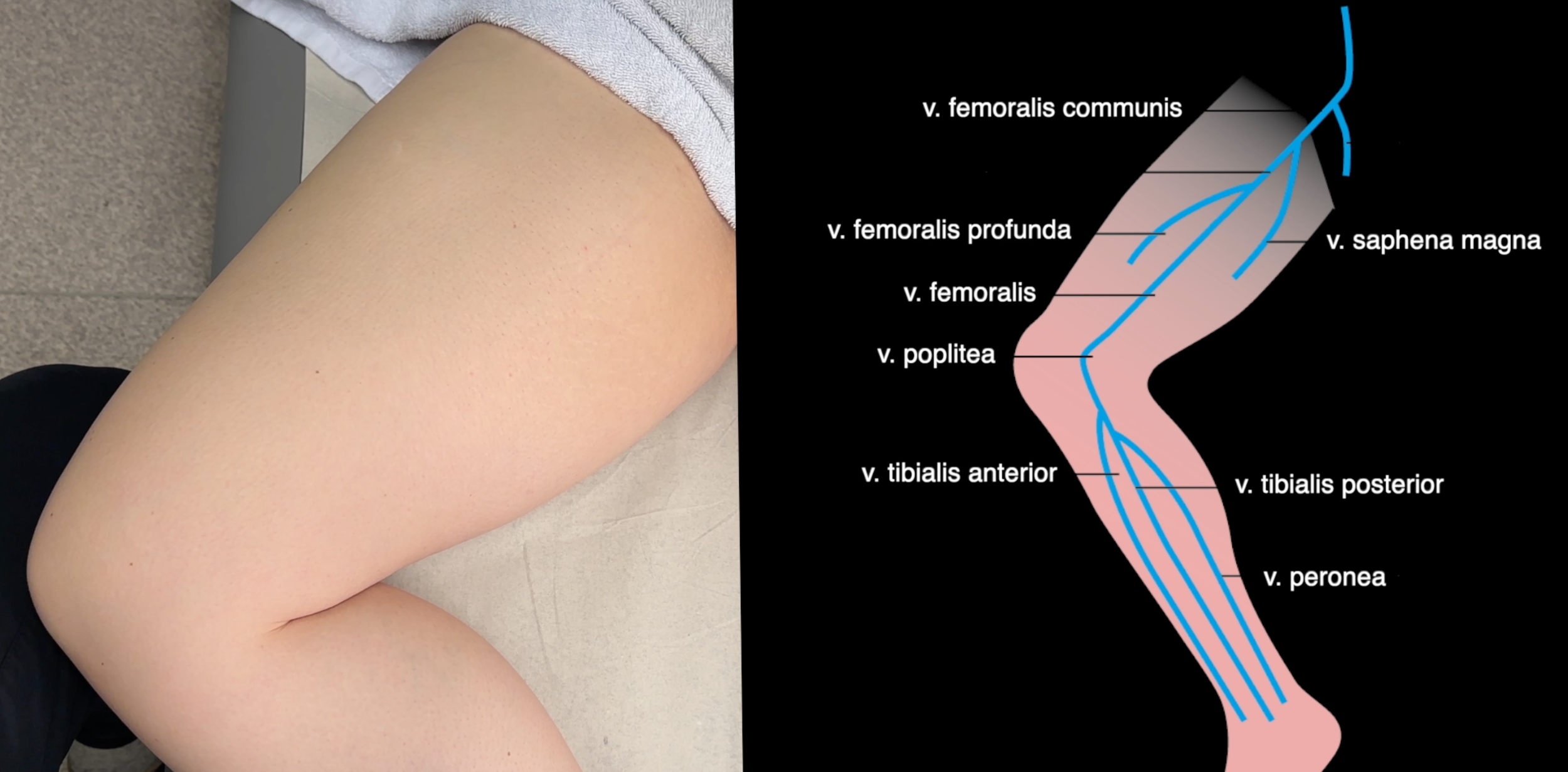 Dyp venetrombose (DVT)