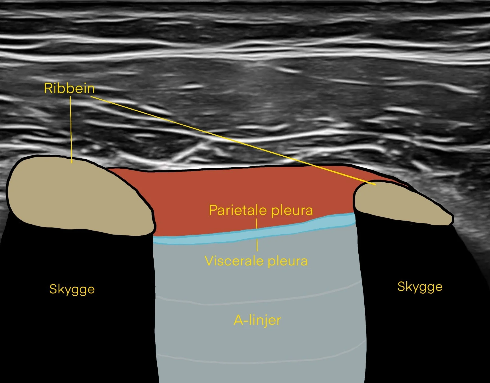 Pneumothorax
