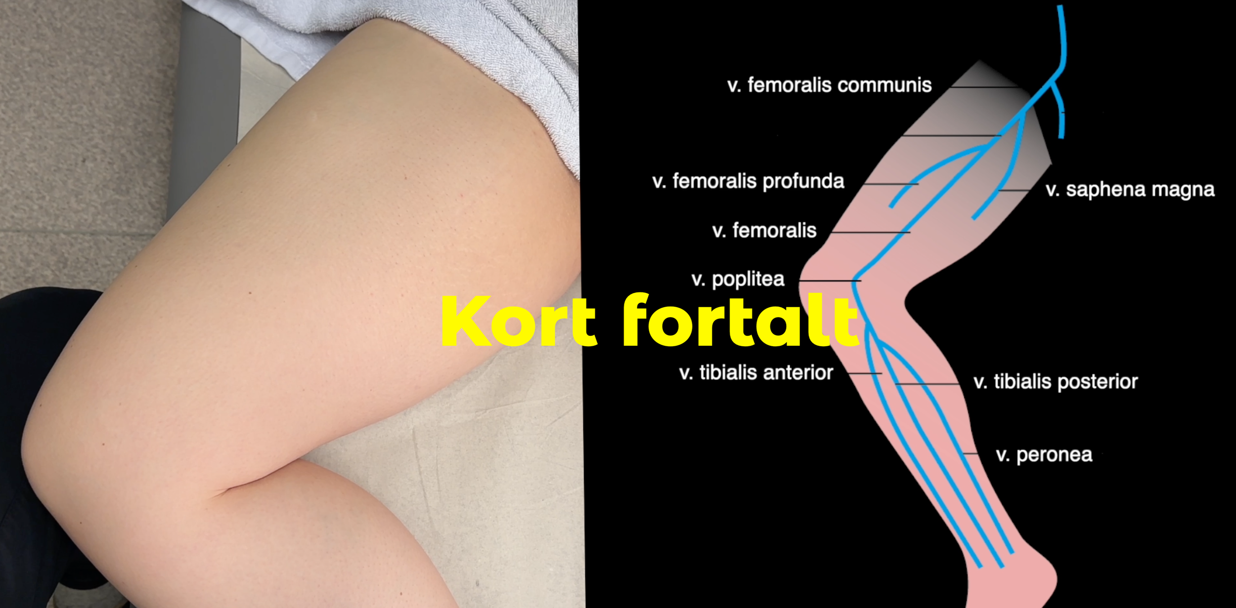 Dyp venetrombose (DVT)