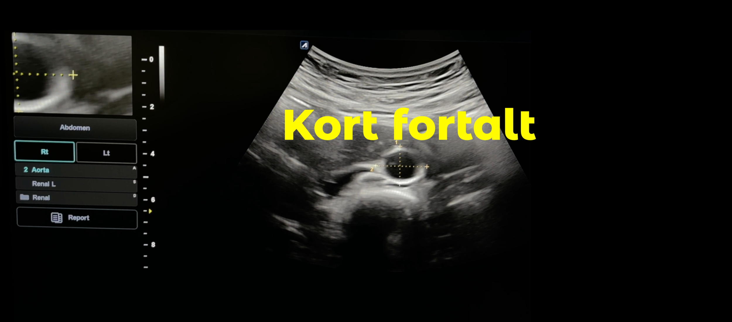 Abdominalt aortaaneurisme (AAA)