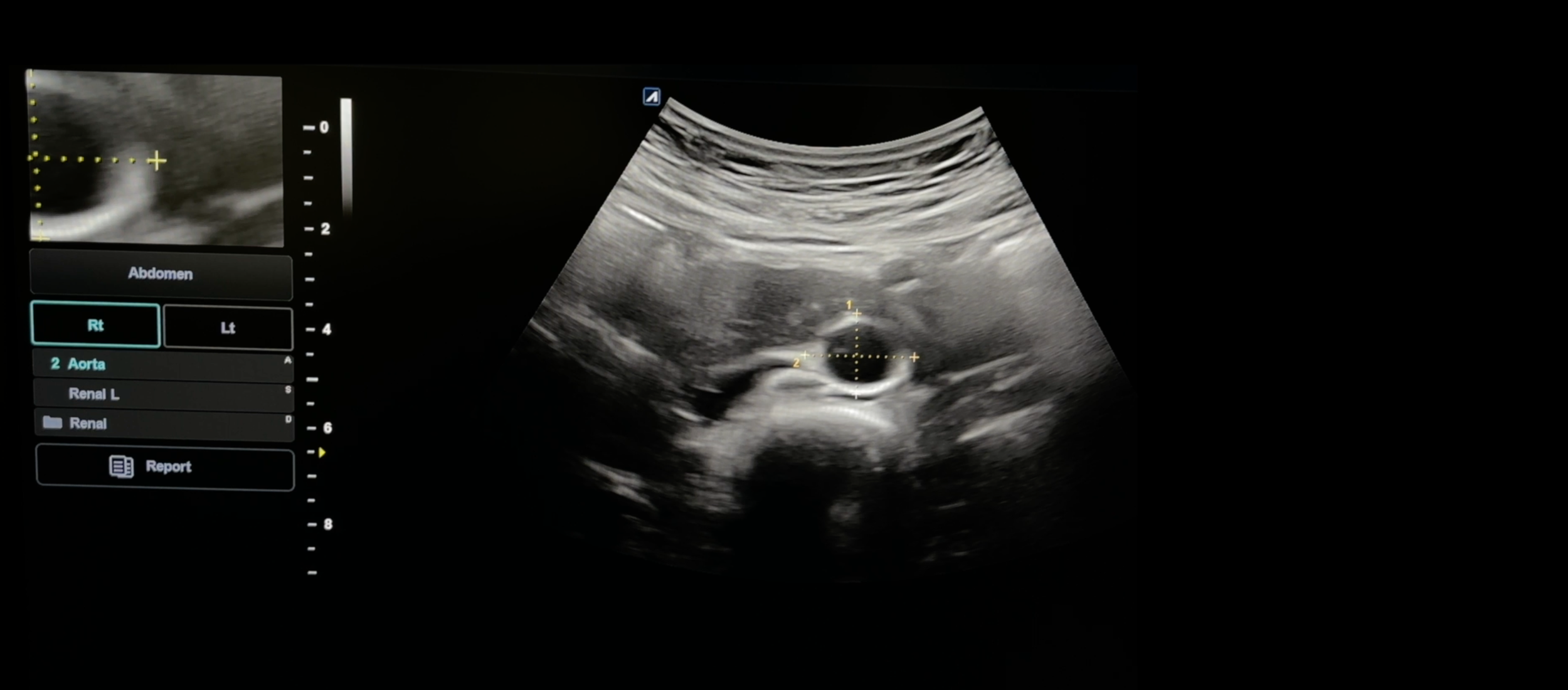 Abdominalt aortaaneurisme (AAA)