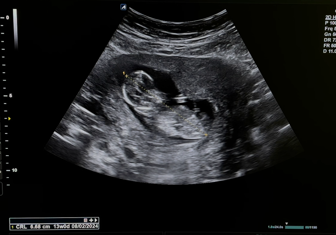 Gynekologisk ultralyd i allmennpraksis