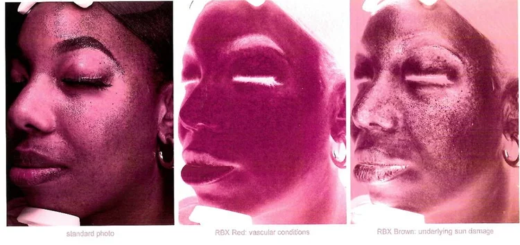 VISIA Skin Analysis — Wallace Skin & Body Institute