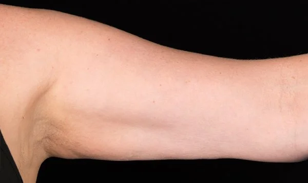 Coolsculpting treatments near Forney, Texas