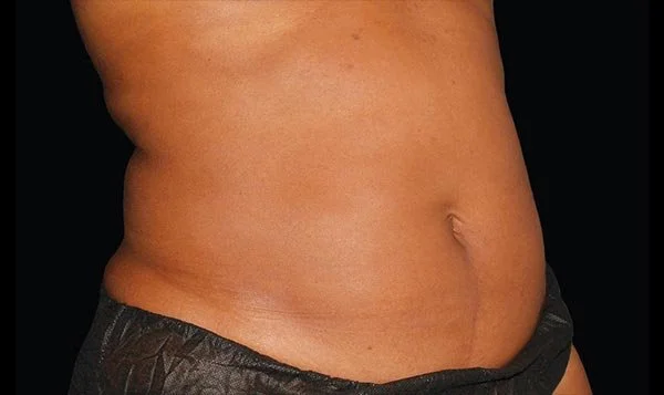 CoolTone Treatments Forney, Texas