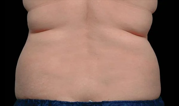 Weight loss treatments near Forney, Texas