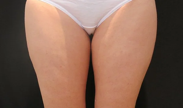 Coolsculpting for cellulite