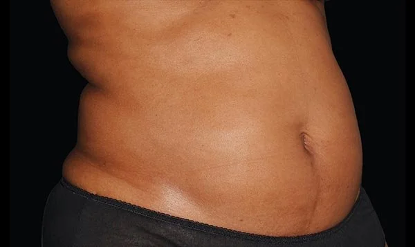 ab toning treatments near Forney, Texas