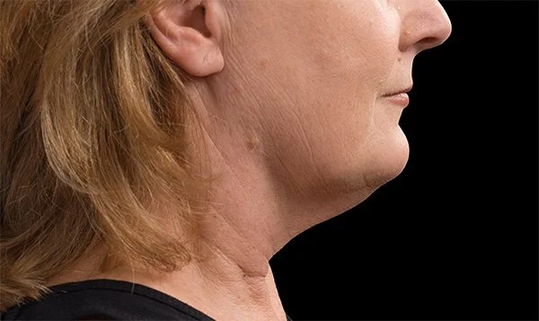 Coolsculpting and CoolTone Forney Texas