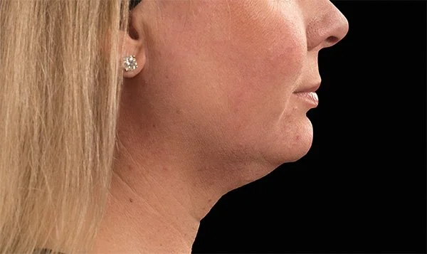 How to get rid of my double chin?