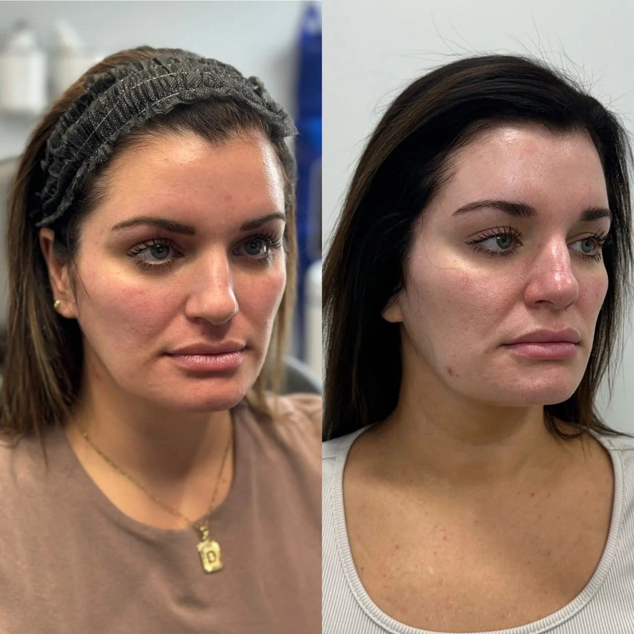 Side-by-side comparison of a woman before and after a cosmetic procedure. Left image shows her before with a headband, and right image shows her after without a headband.