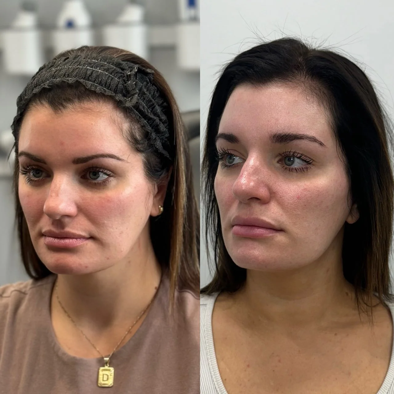 Side-by-side comparison of a woman's face before and after a beauty treatment, showing subtle changes in skin texture and tone.