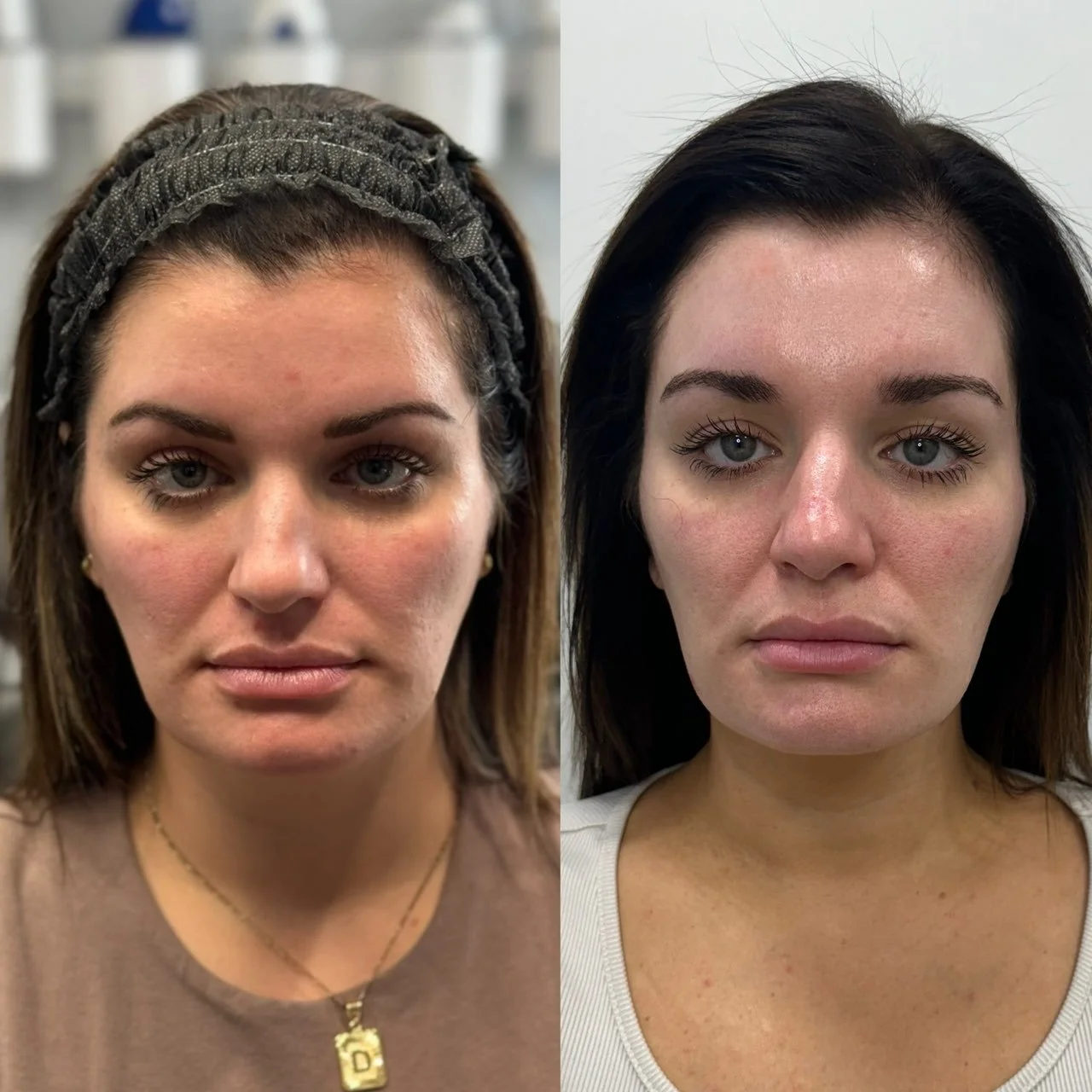 Side-by-side comparison of a woman's face before and after a skincare treatment. The left image shows her wearing a headband and a necklace, while the right image shows noticeable improvements in skin texture and tone.