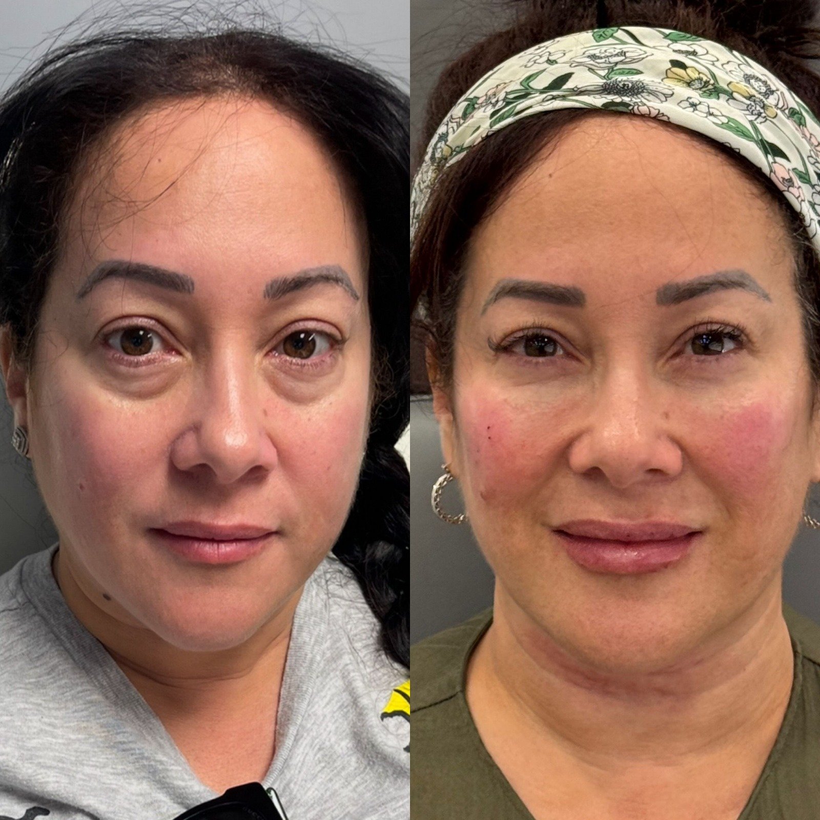 Ojeras suavizadas y pómulos y labios con un volumen armónico.
