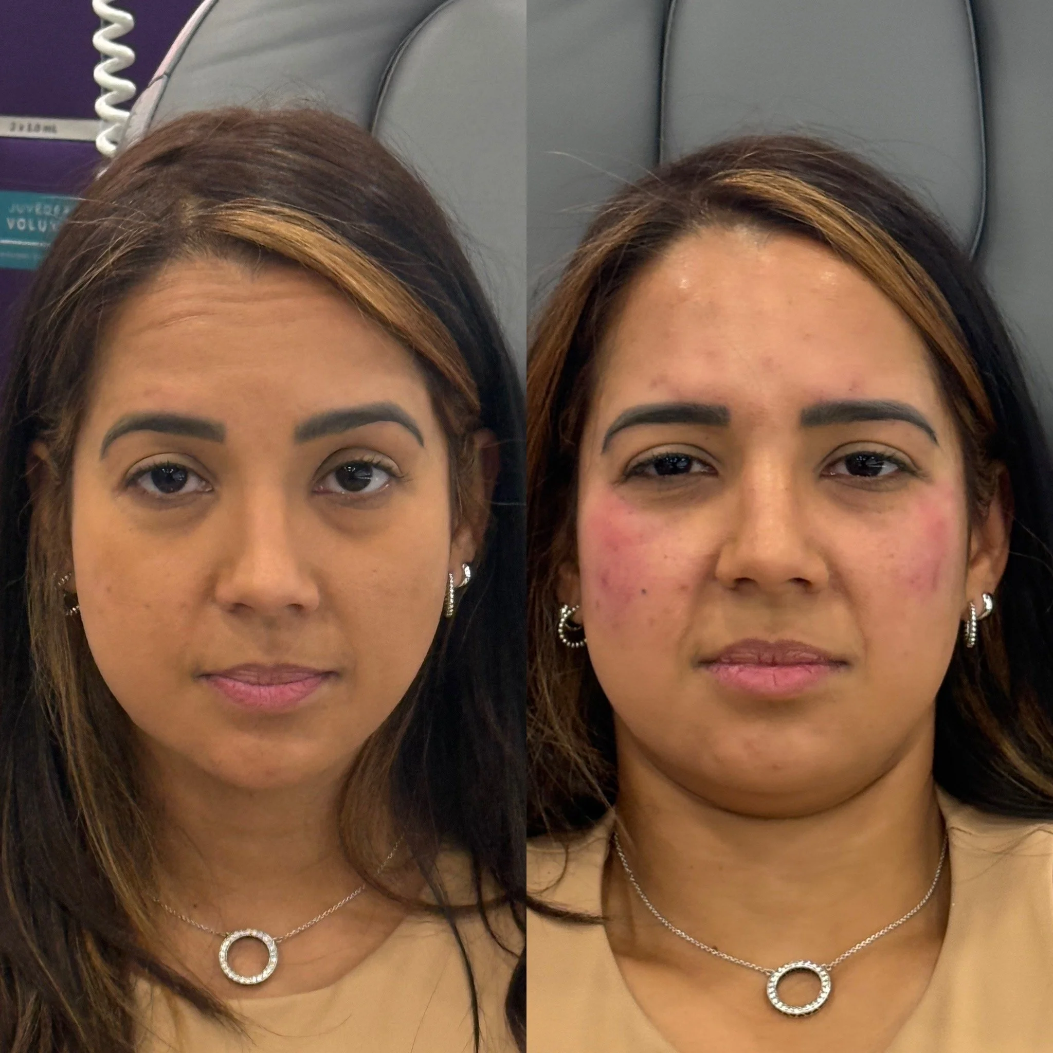 Pómulos con mayor proyección y frente más lisa.