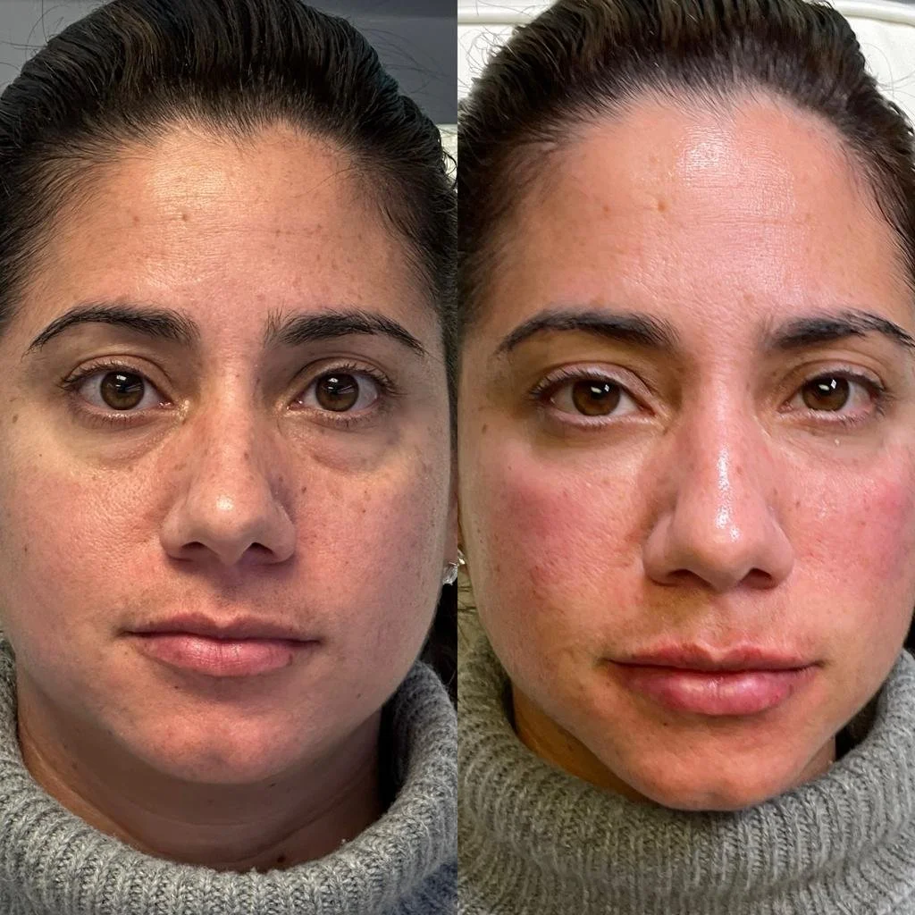 Ojeras atenuadas y labios con un contorno más definido.