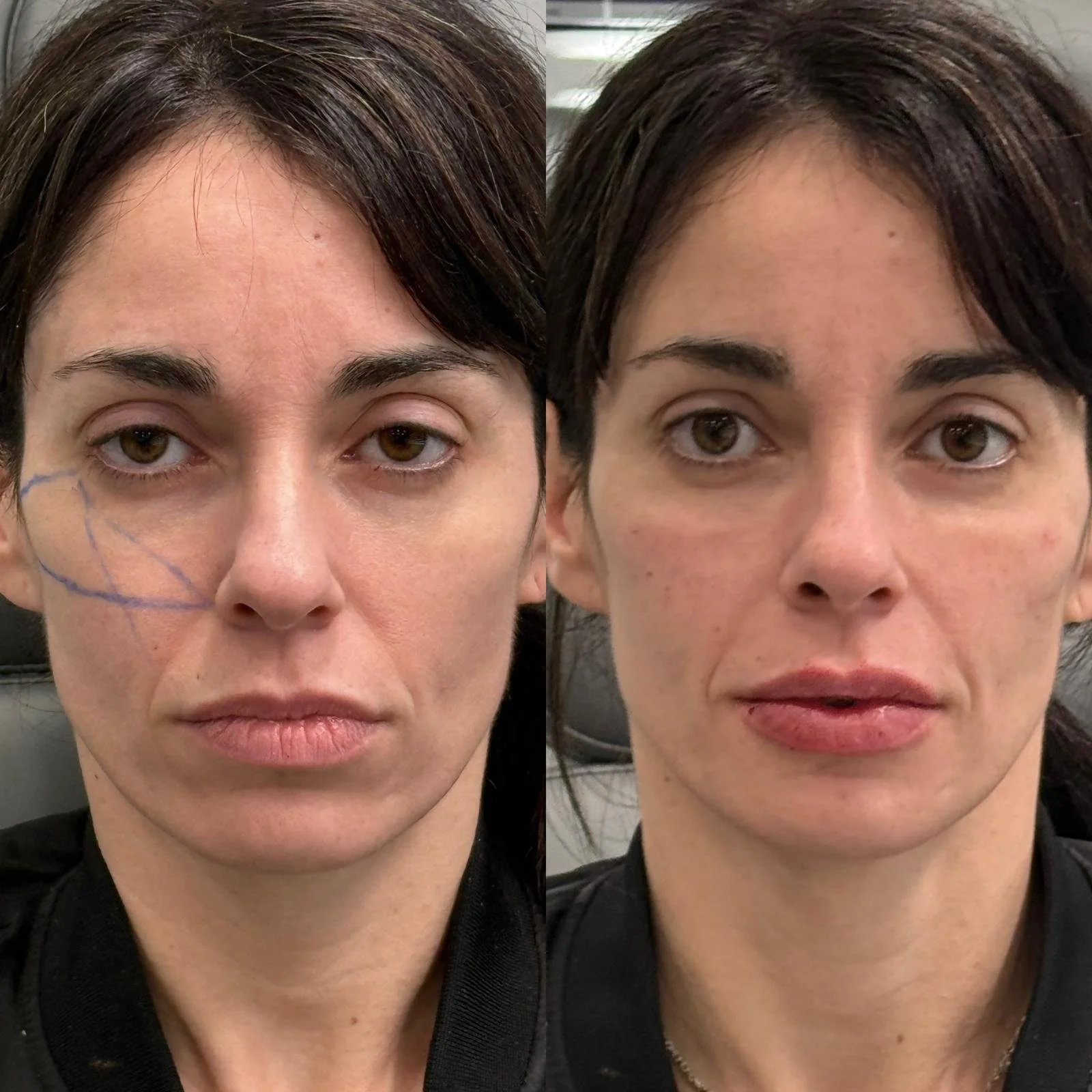 Pómulos proyectados y labios con mayor volumen.